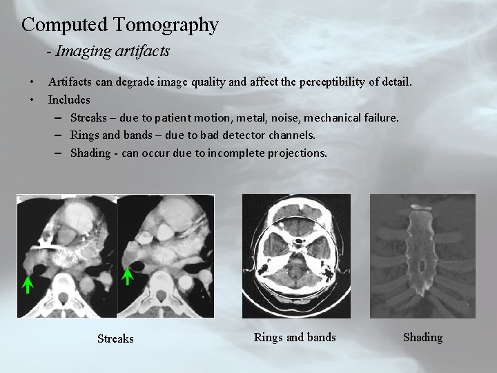 Computed Tomography - Imaging artifacts • • Artifacts can degrade image quality and affect