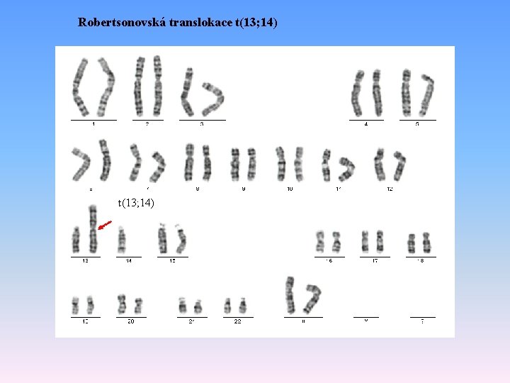 Robertsonovská translokace t(13; 14) 