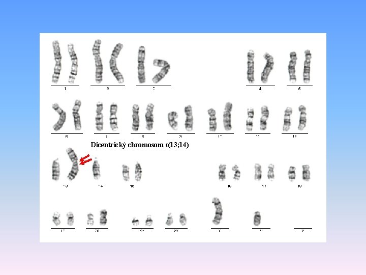 Dicentrický chromosom t(13; 14) 