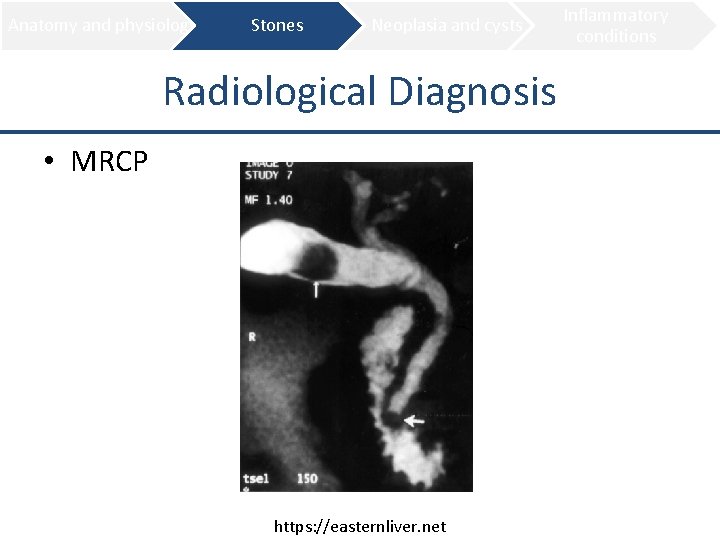 Anatomy and physiology Stones Neoplasia and cysts Radiological Diagnosis • MRCP https: //easternliver. net