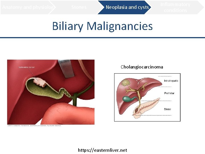 Anatomy and physiology Stones Neoplasia and cysts Inflammatory conditions Biliary Malignancies Cholangiocarcinoma https: //easternliver.