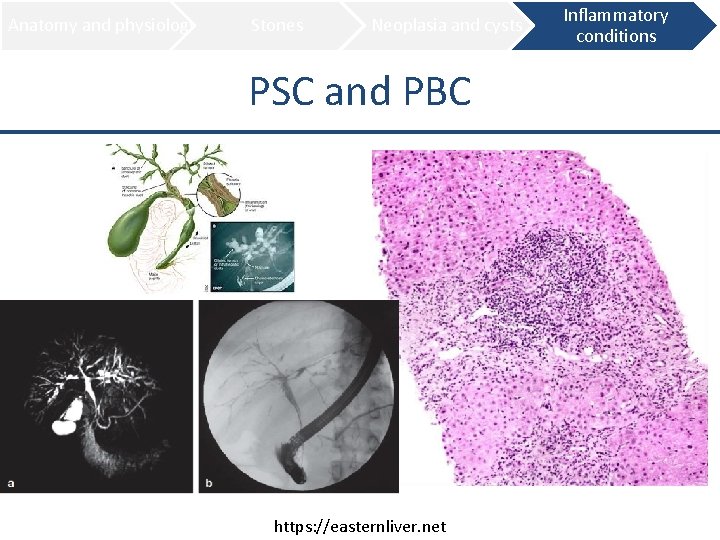 Anatomy and physiology Stones Neoplasia and cysts PSC and PBC https: //easternliver. net Inflammatory