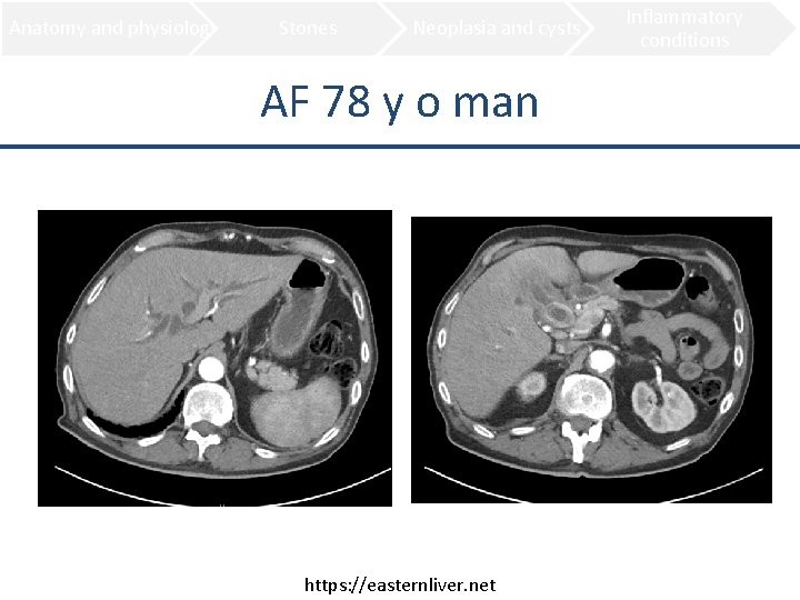 Anatomy and physiology Stones Neoplasia and cysts AF 78 y o man https: //easternliver.