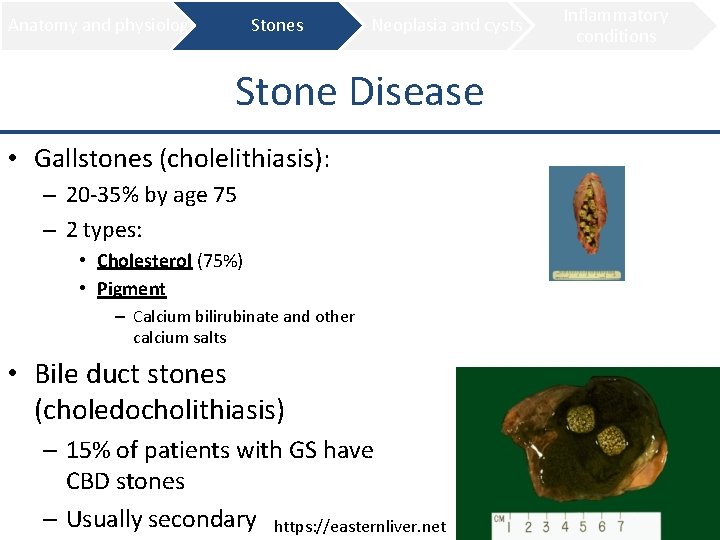 Anatomy and physiology Stones Neoplasia and cysts Stone Disease • Gallstones (cholelithiasis): – 20