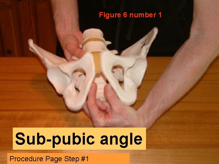 Figure 6 number 1 Sub-pubic angle Procedure Page Step #1 