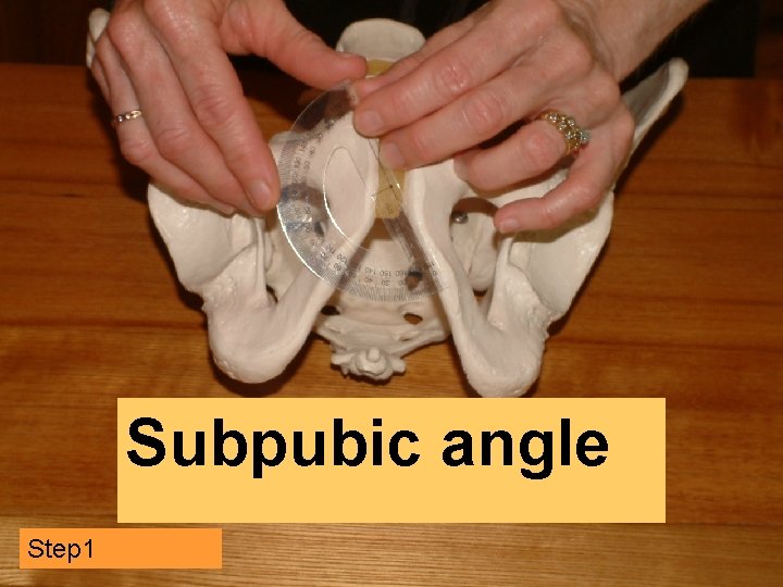 Subpubic angle Step 1 