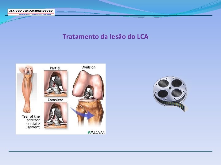 Tratamento da lesão do LCA 