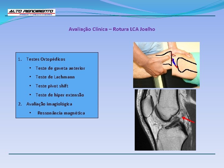 Avaliação Clínica – Rotura LCA Joelho 1. Testes Ortopédicos • Teste de gaveta anterior