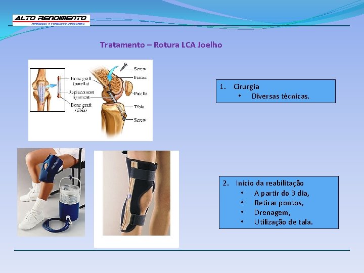 Tratamento – Rotura LCA Joelho 1. Cirurgia • Diversas técnicas. 2. Inicio da reabilitação