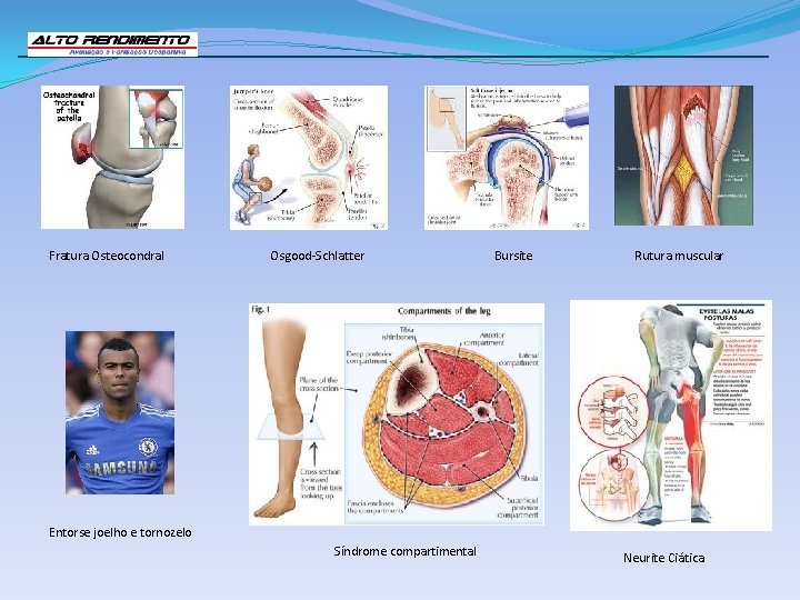 Fratura Osteocondral Osgood-Schlatter Bursite Rutura muscular Entorse joelho e tornozelo Síndrome compartimental Neurite Ciática