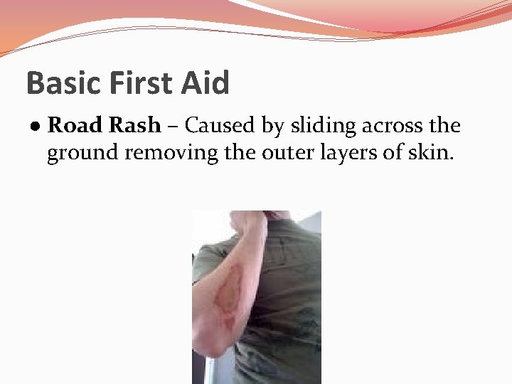 Basic First Aid ● Road Rash – Caused by sliding across the ground removing