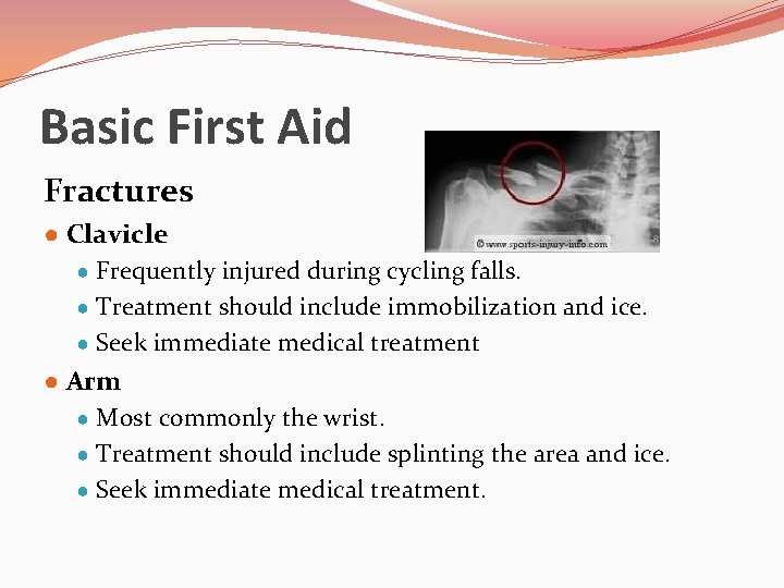 Basic First Aid Fractures ● Clavicle ● Frequently injured during cycling falls. ● Treatment