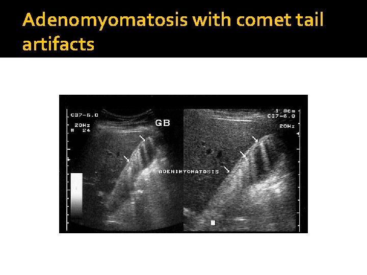 Adenomyomatosis with comet tail artifacts 