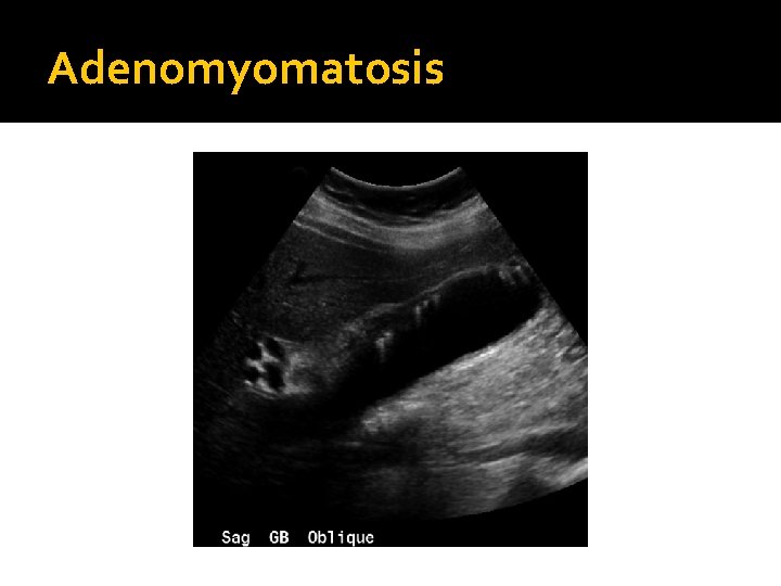 Adenomyomatosis 