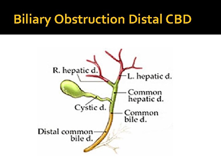 Biliary Obstruction Distal CBD 