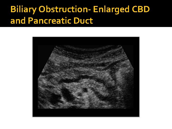 Biliary Obstruction- Enlarged CBD and Pancreatic Duct 