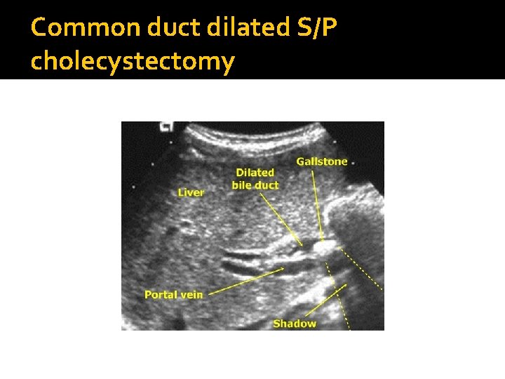 Common duct dilated S/P cholecystectomy 