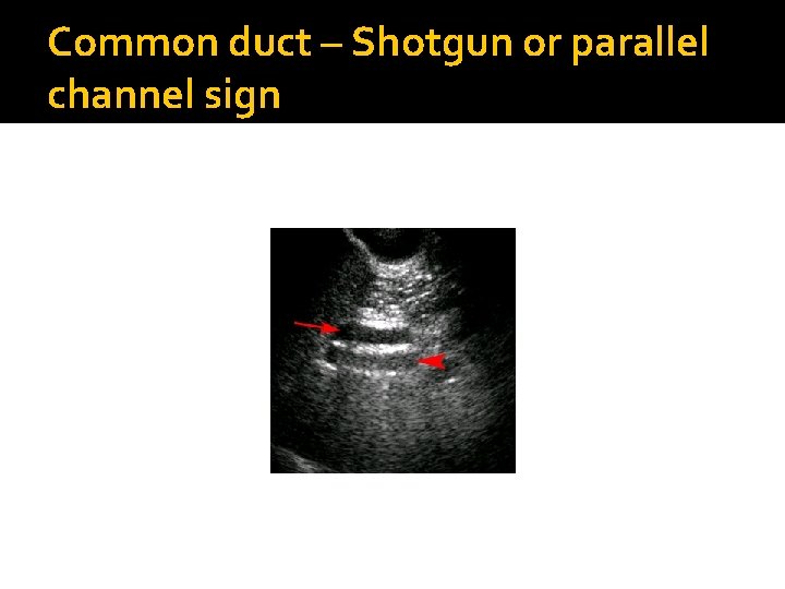 Common duct – Shotgun or parallel channel sign 
