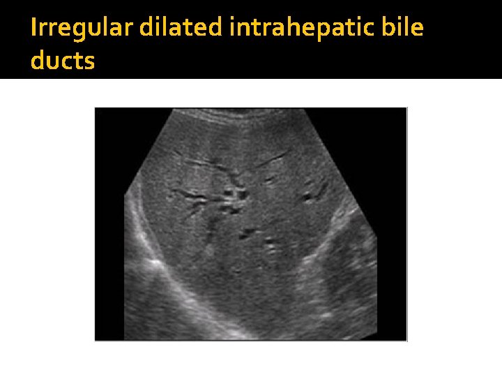 Irregular dilated intrahepatic bile ducts 
