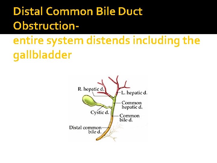 Distal Common Bile Duct Obstructionentire system distends including the gallbladder 