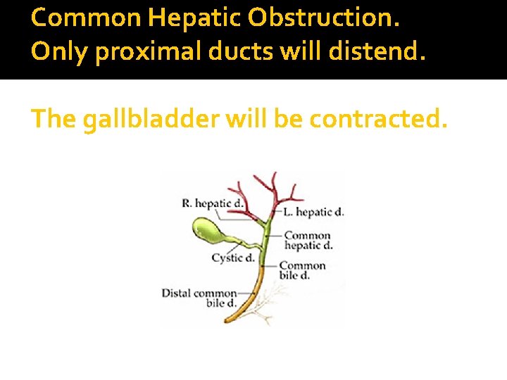 Common Hepatic Obstruction. Only proximal ducts will distend. The gallbladder will be contracted. 