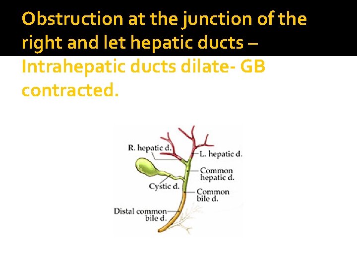 Obstruction at the junction of the right and let hepatic ducts – Intrahepatic ducts