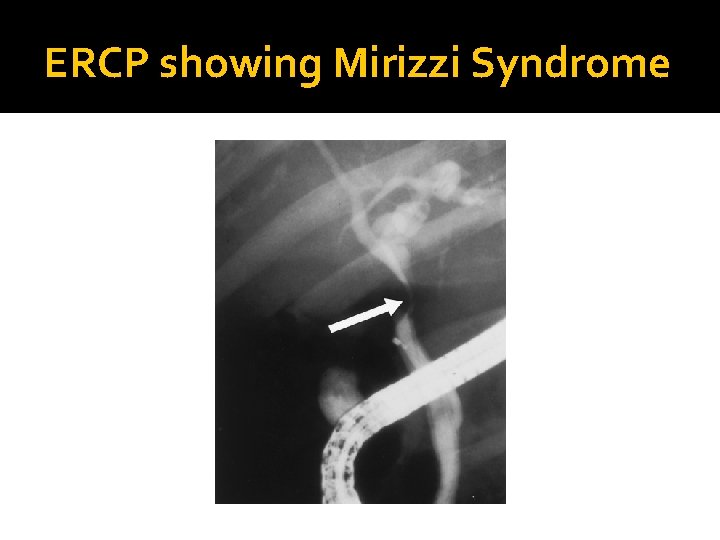 ERCP showing Mirizzi Syndrome 