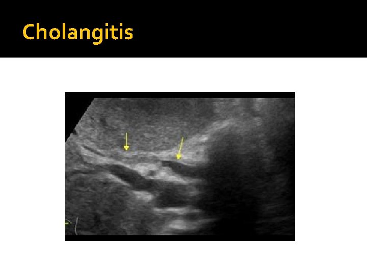 Cholangitis 