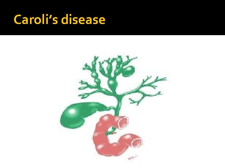Caroli’s disease 