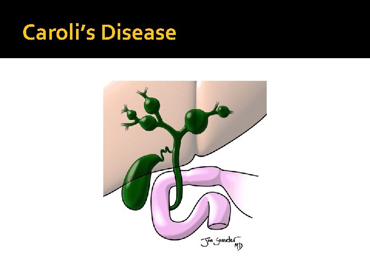 Caroli’s Disease 