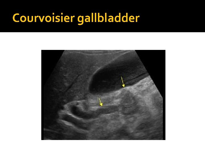 Courvoisier gallbladder 