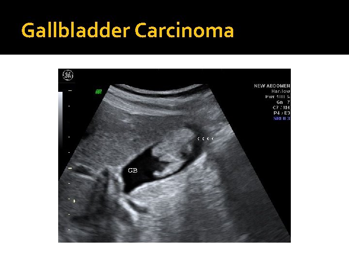 Gallbladder Carcinoma 