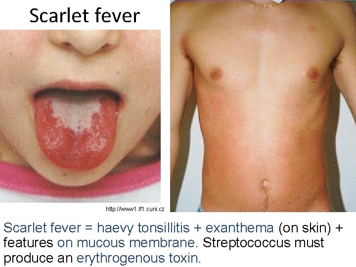 Scarlet fever http: //www 1. lf 1. cuni. cz Scarlet fever = haevy tonsillitis