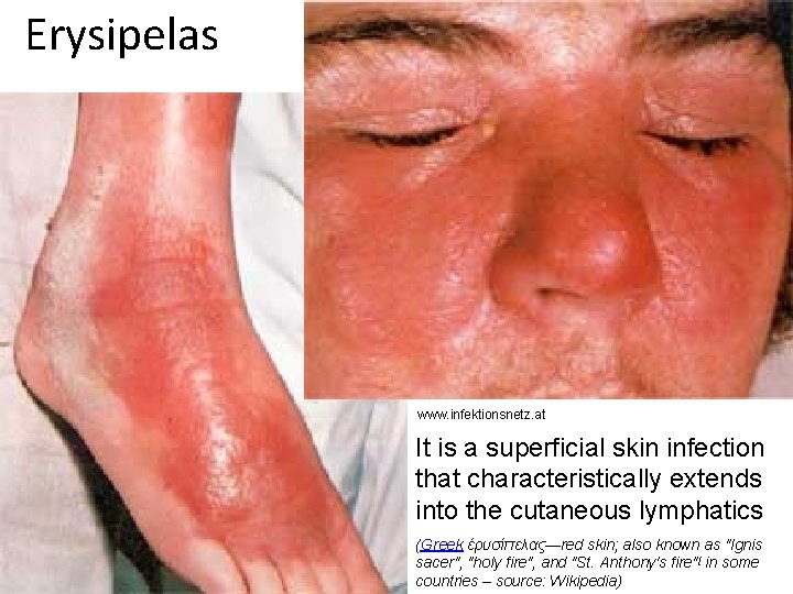 Erysipelas www. infektionsnetz. at It is a superficial skin infection that characteristically extends into