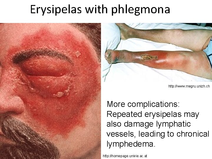 Erysipelas with phlegmona http: //www. megru. unizh. ch More complications: Repeated erysipelas may also
