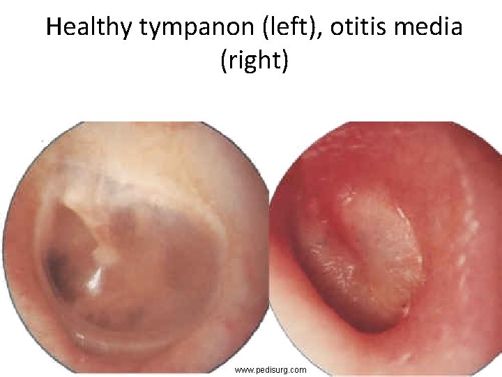 Healthy tympanon (left), otitis media (right) www. pedisurg. com 