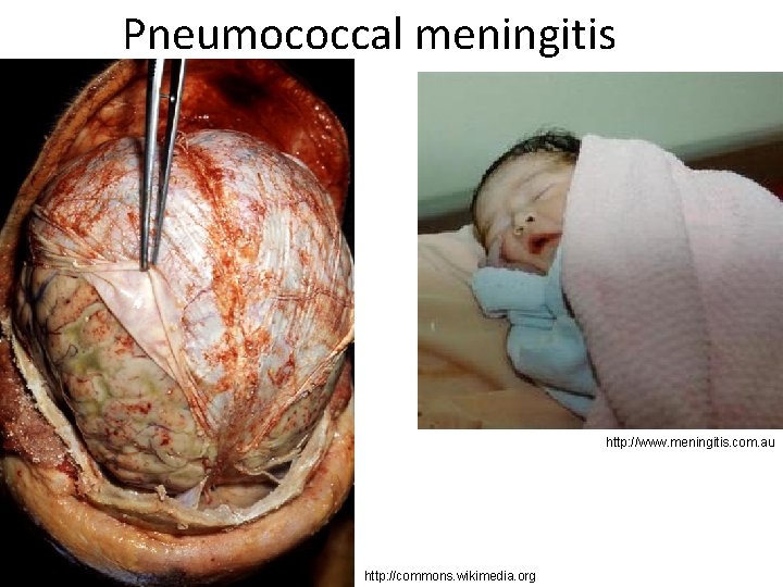 Pneumococcal meningitis http: //www. meningitis. com. au http: //commons. wikimedia. org 