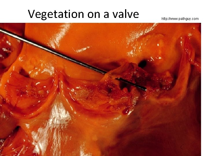 Vegetation on a valve http: //www. pathguy. com 