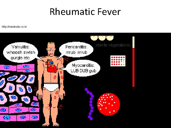 Rheumatic Fever http: //mednote. co. kr 