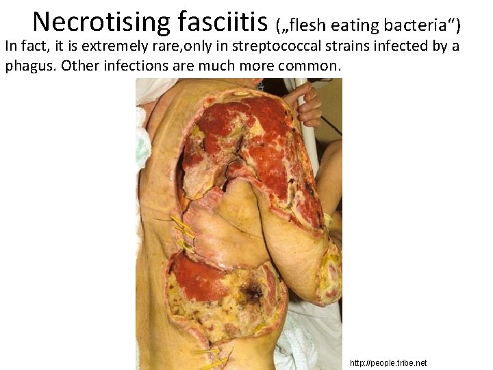 Necrotising fasciitis („flesh eating bacteria“) In fact, it is extremely rare, only in streptococcal