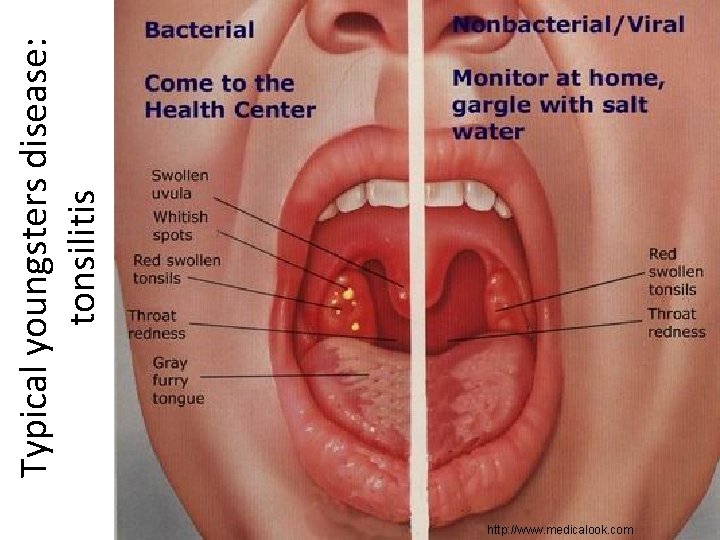 http: //www. medicalook. com Typical youngsters disease: tonsilitis 