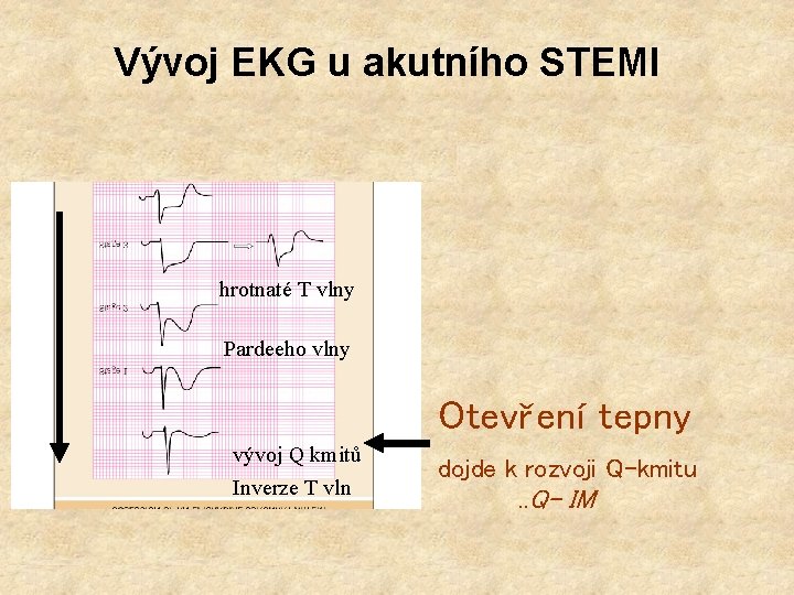 Vývoj EKG u akutního STEMI hrotnaté T vlny Pardeeho vlny Otevření tepny vývoj Q