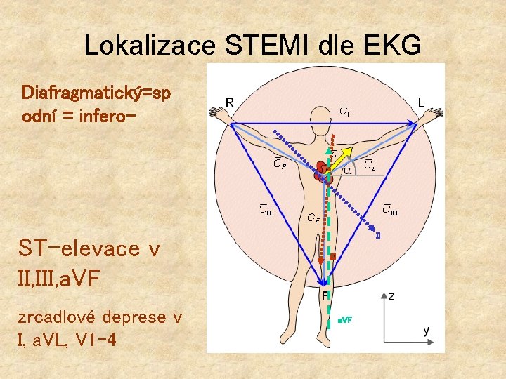 Lokalizace STEMI dle EKG Diafragmatický=sp odní = infero- ST-elevace v II, III, a. VF