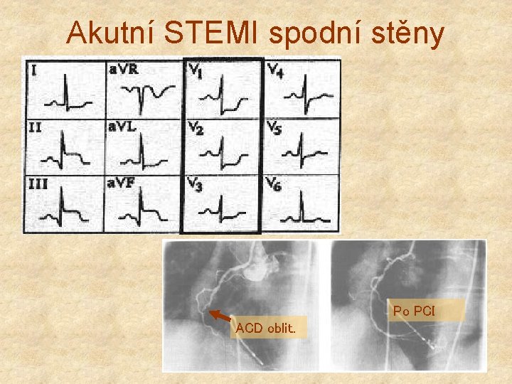 Akutní STEMI spodní stěny Po PCI ACD oblit. 