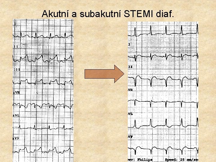 Akutní a subakutní STEMI diaf. 