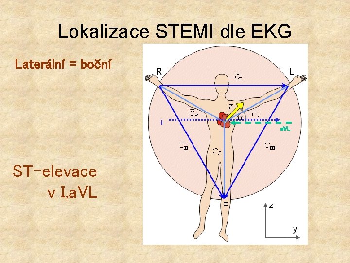 Lokalizace STEMI dle EKG Laterální = boční I a. VL ST-elevace v I, a.