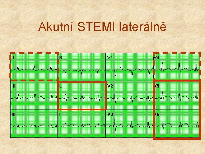 Akutní STEMI laterálně 