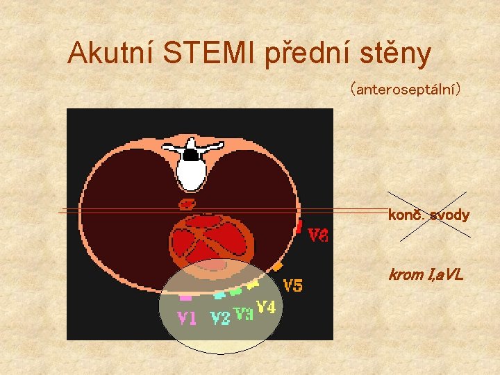 Akutní STEMI přední stěny (anteroseptální) konč. svody krom I, a. VL 