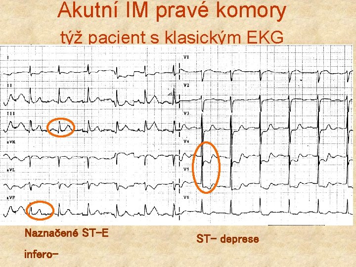 Akutní IM pravé komory týž pacient s klasickým EKG Naznačené ST-E infero- ST- deprese