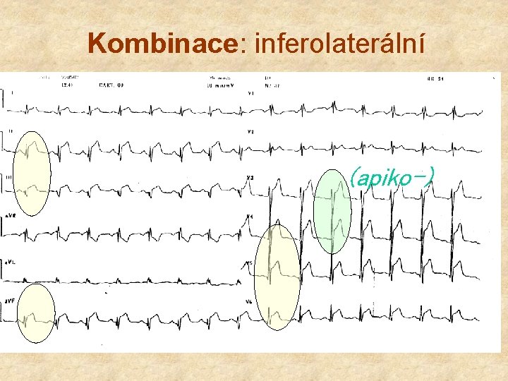 Kombinace: inferolaterální (apiko-) 
